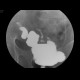 Inflammatory stenosis of sigmoid colon, sigmoid fistula, irrigography: RF - Fluoroscopy